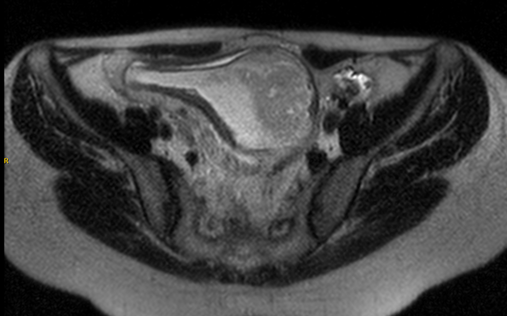 Pouchitis El Probiótico